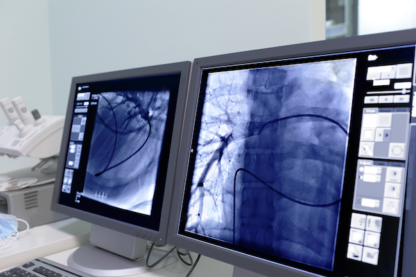 lungscreening