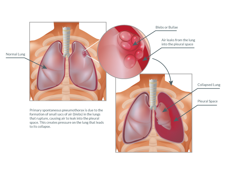 pulmonary bleb