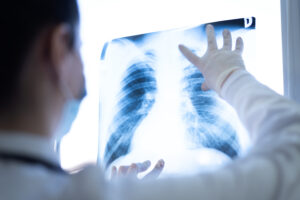 What To Expect From a Lung Cancer Screening